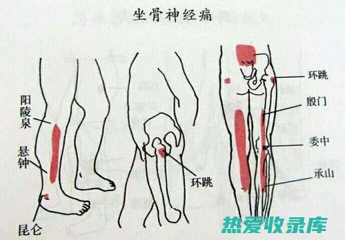 坐骨神经痛中药配方