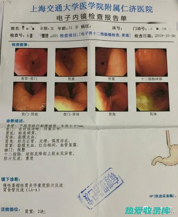 胃炎胃溃疡中药处方：调理脾胃、修复黏膜 (胃炎胃溃疡中成药)