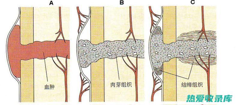 骨折消肿外敷中药：帮助缓解疼痛和促进愈合 (骨折消肿外敷偏方大全)