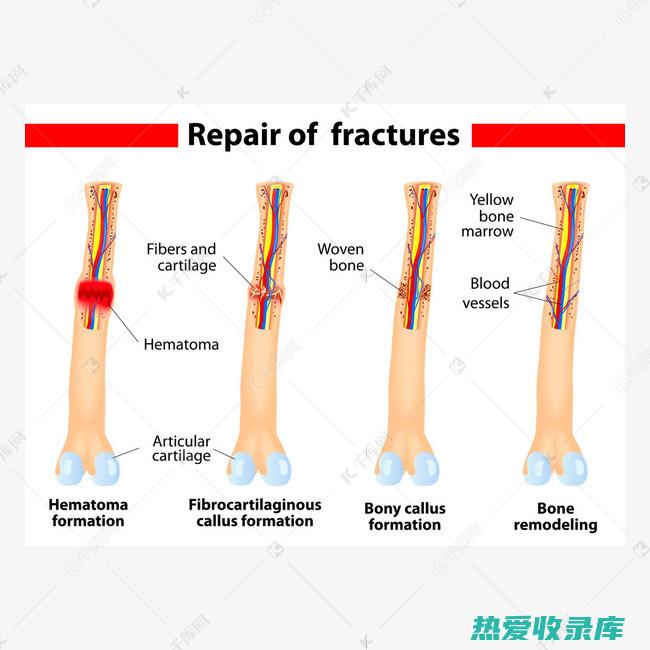 骨折外敷偏方大全