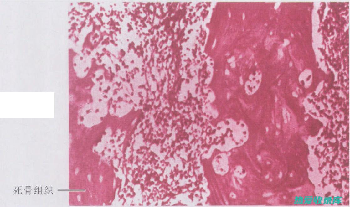 慢性骨髓炎的中药治疗指南 (慢性骨髓炎的症状表现)