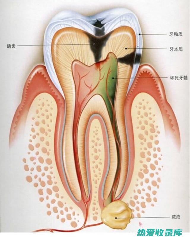 治疗牙髓炎的中药方剂 (治疗牙髓炎的特效药)