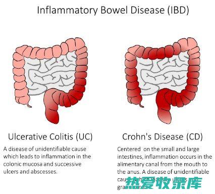 愈合肠炎的中药